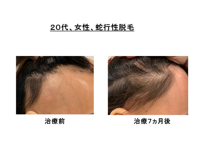 汎発性脱毛　病院